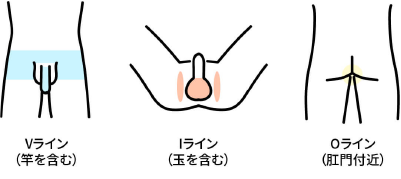 メンズ脱毛(VIO)トライアル料金