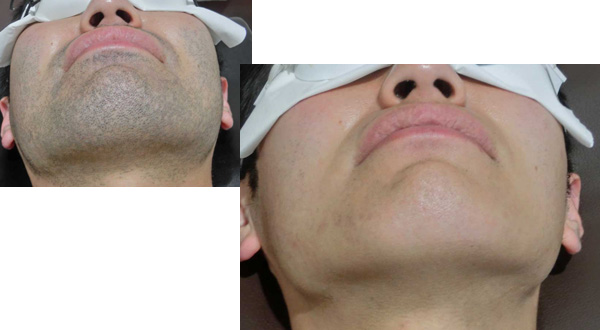 船橋ラグジーのメンズ脱毛 症例01