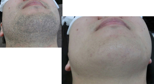 メンズ脱毛LUXY 症例02(船橋)