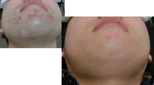 船橋のメンズ脱毛 症例03