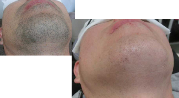 メンズ脱毛(船橋店) 症例04